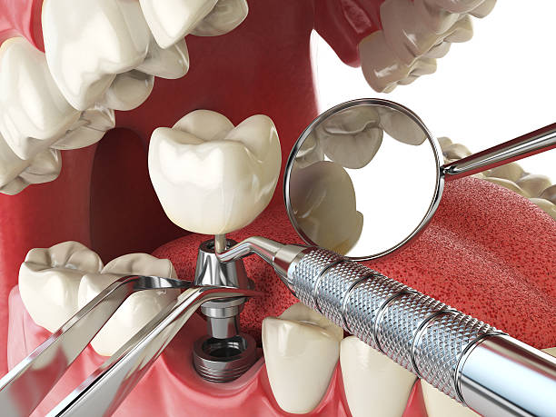Best Emergency Dentist for Knocked-Out Tooth in Bonners Ferry, ID